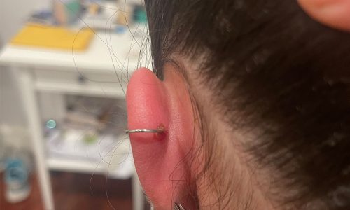 5 Ways to Heal Cartilage Piercing Bumps - wikiHow