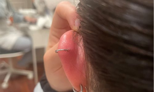 How to take care of a infected daith piercing - Quora