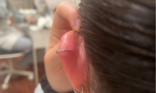 I am almost sure this is infected. I put in NoPull discs, but I am also  afraid that a keloid might have formed. I had an irritation bump at the  front and